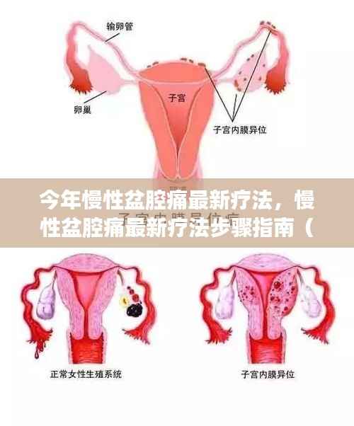 今年慢性盆腔痛最新疗法详解,步骤指南与初学者进阶教程