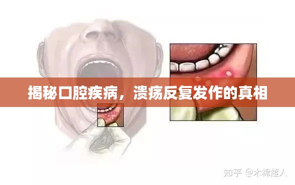 揭秘口腔疾病,溃疡反复发作的真相