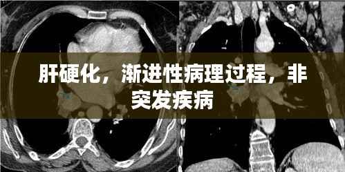 肝硬化,渐进性病理过程,非突发疾病